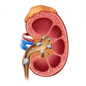 Diagram of a kidney with kidney stones inside.