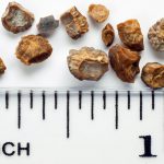 A ruler next to several kidney stones of various sizes.