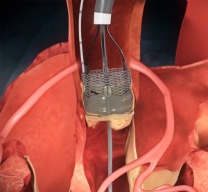 LOTUS edge aortic valve system in body