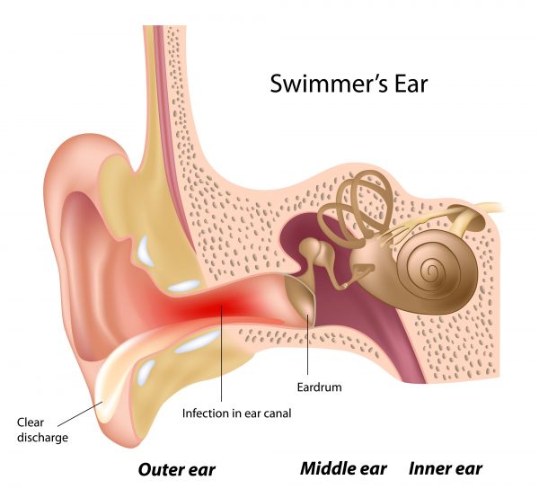 A diagram of the inside of a human ear, showing the outer ear, middle ear, and inner ear. The ear is infected with Swimmer’s Ear, displayed by an inflamed infection in the ear canal between a normal looking eardrum and clear discharge coming out of the opening of the ear.