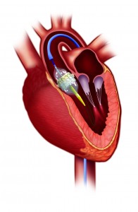 heart model with TAVR