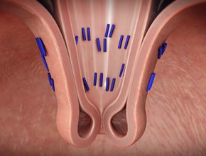 A 3D mockup of the inside of the esophagus after treatment