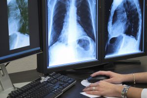 X-ray of lungs on 3 computer monitors