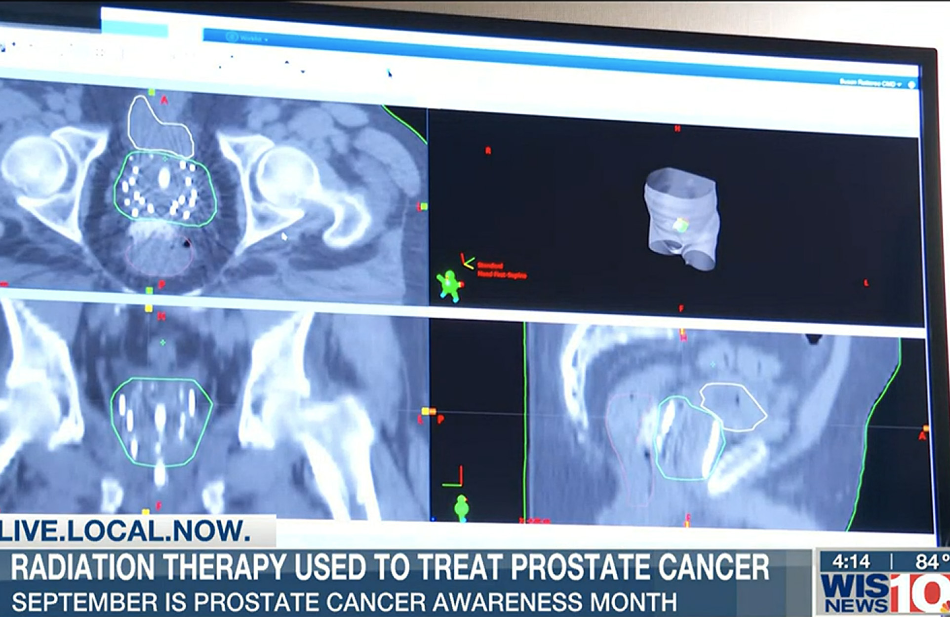 MRI of radioactive seeds implanted in prostate