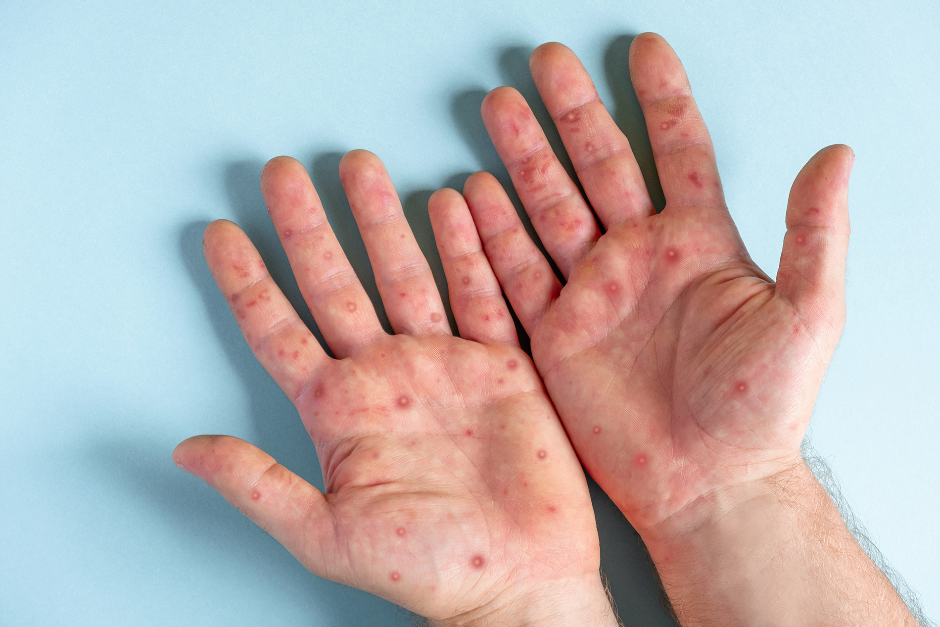 What You Should Know About Monkeypox | Lexington Medical Center Blog ...