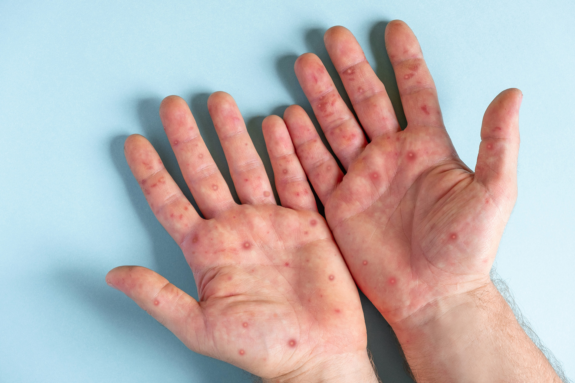 Man's hands with monkeypox rash