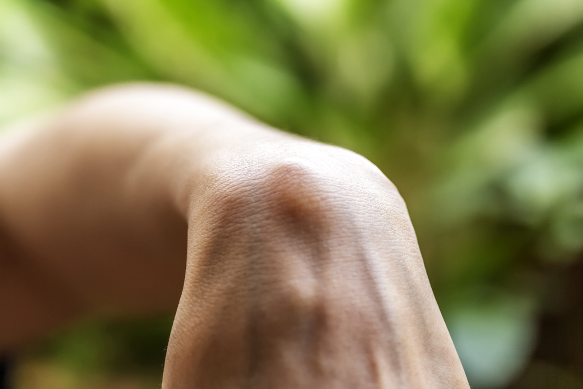 Hand with ganglion cyst on wrist