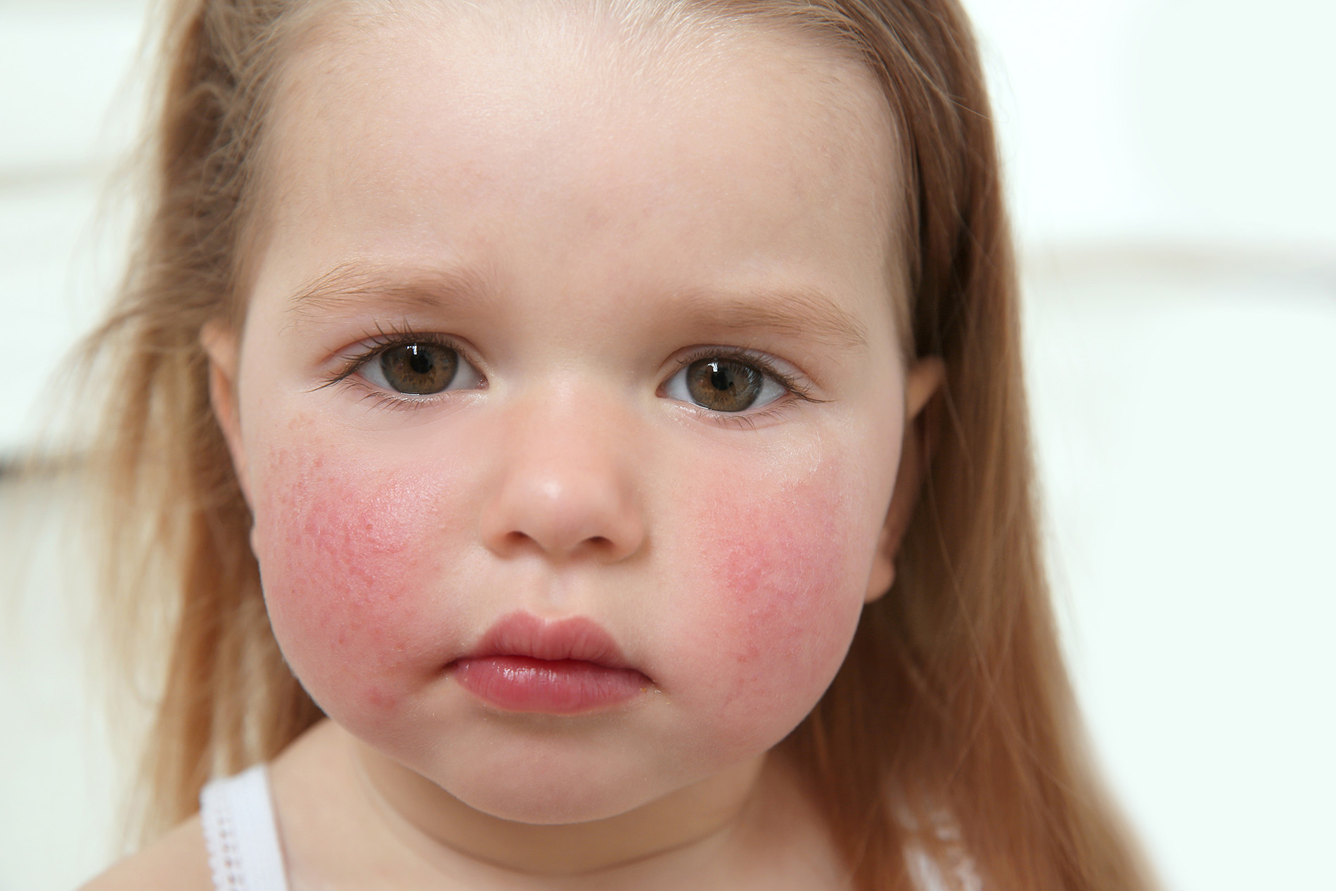Little girl with red rash on face from Fifth's Disease