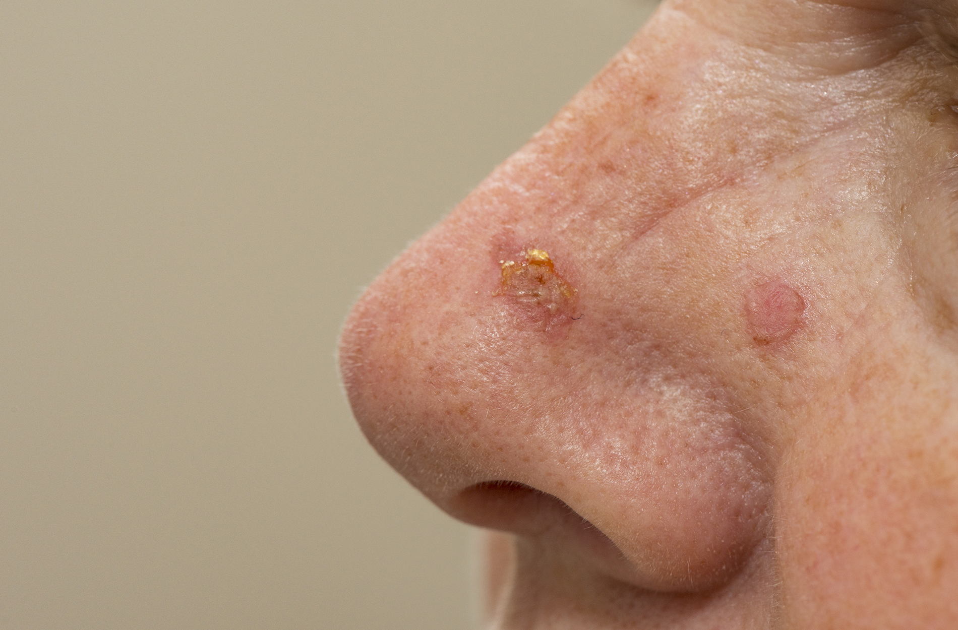 Squamous cell carcinoma on side of woman's nose