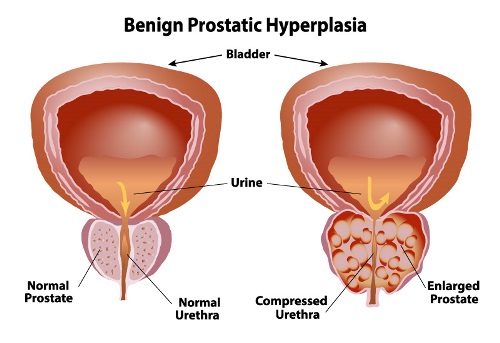 Illustration of normal prostate and enlarged prostate