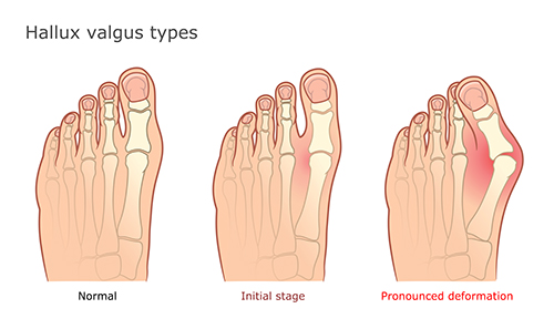 Anatomical illustration of normal joint and one with severe bunion deformity