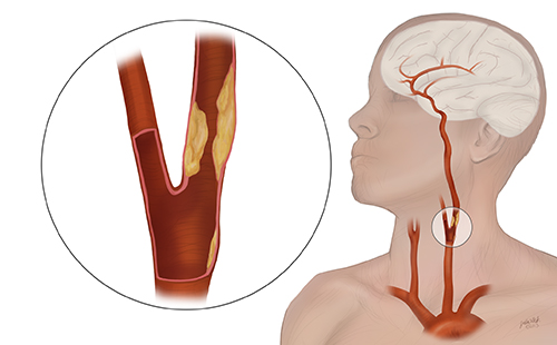 Anatomical drawing of clogged carotid artery in neck