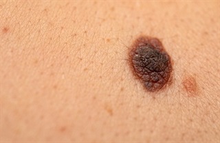 Dark irregularly shaped mole