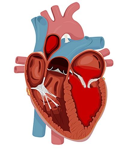 Medical illustration of heart with mitral valve regurgitation