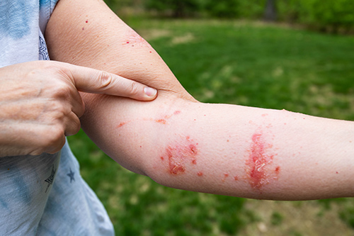 Forearm with poison ivy rash and blisters