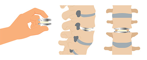 Medical illustration of cervical neck with natural discs and a disc replacement