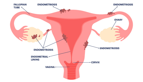 Medical illustration of pelvic cavity with endometriosis
