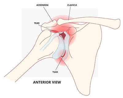 Labrum tear deals