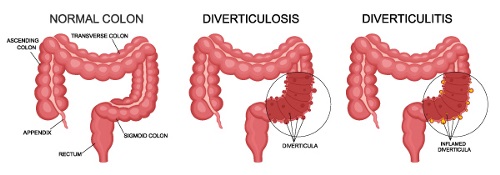 Illustration of normal colon, diverticulosis and diverticulitis