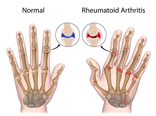 Anatomical drawing of normal hand and hand with rheumatoid arthritis