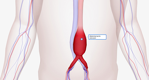 Medical illustration of bulging abdominal aortic aneurysm