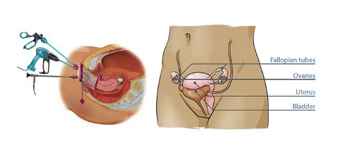 Anatomical drawing of VNotes instrument and female organs