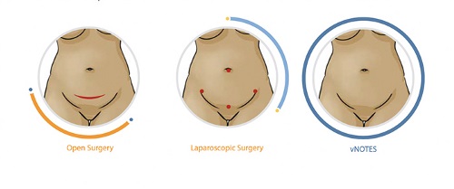 Anatomical drawings of incisions on belly after hysterectomy