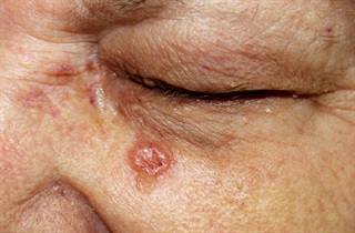 Basal cell carcinoma under elderly woman's eye